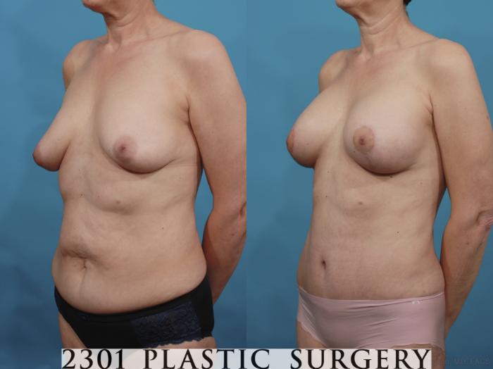 Before & After Breast Augmentation Case 663 Left Oblique View in Fort Worth, Plano, & Frisco, Texas