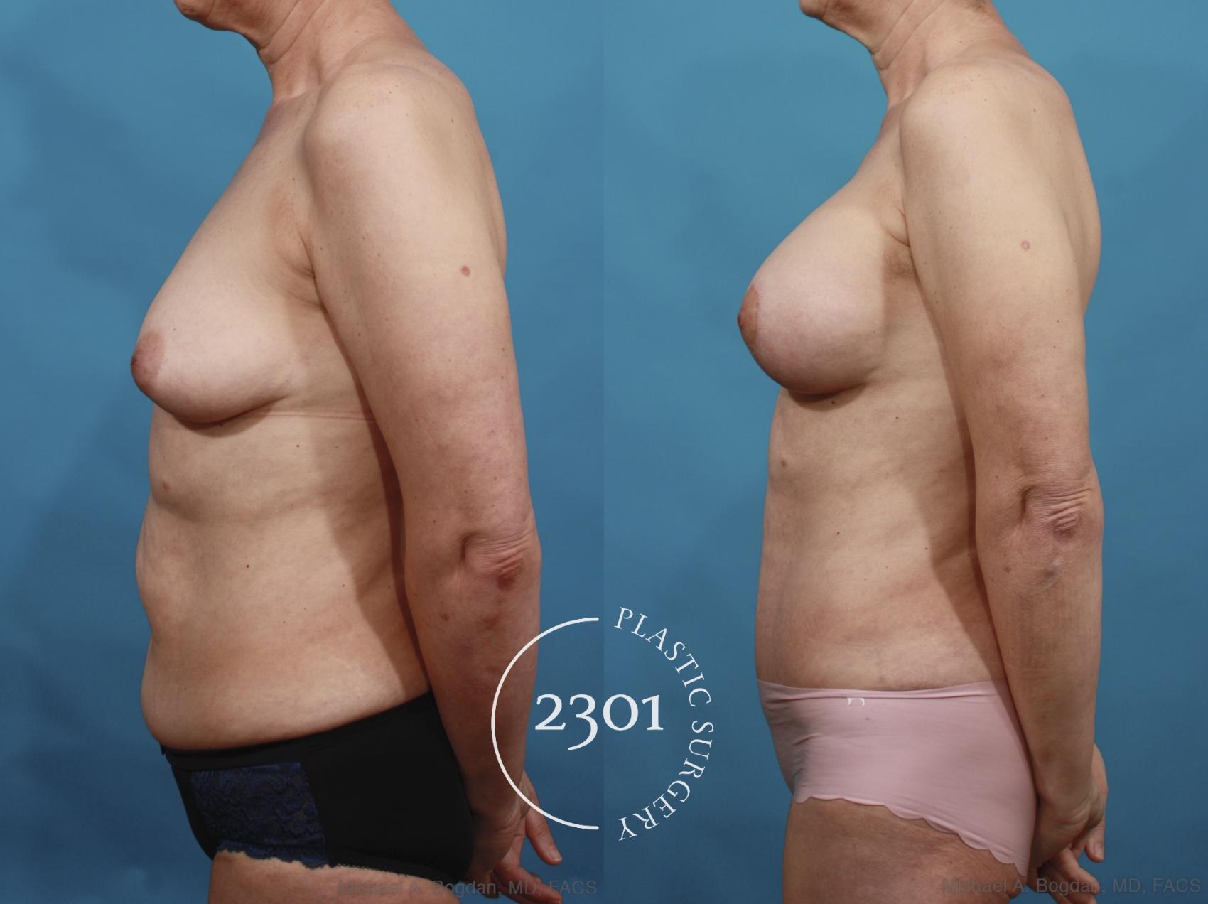 Before & After Silicone Implants Case 663 Left Side View in Fort Worth, Plano, & Frisco, Texas