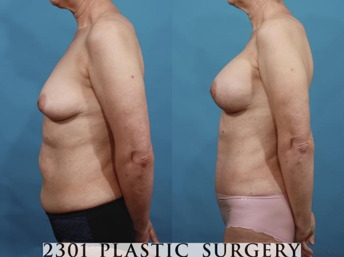 Before & After Breast Augmentation Case 663 Left Side View in Fort Worth, Plano, & Frisco, Texas