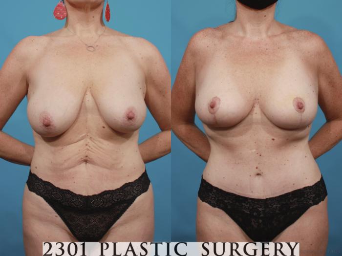Before & After Tummy Tuck Case 664 Front View in Fort Worth, Plano, & Frisco, Texas