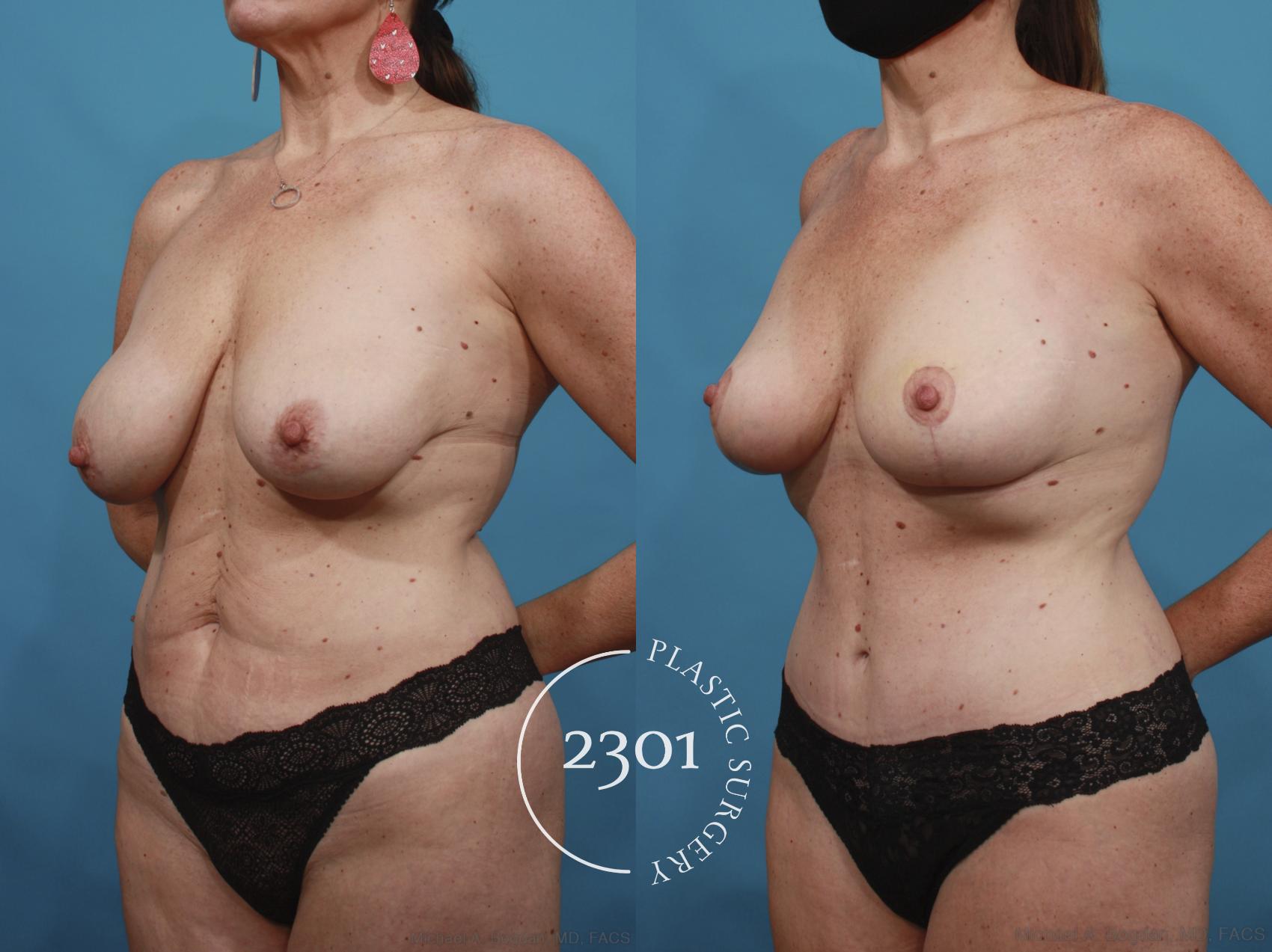 Before & After Mommy Makeover Case 664 Left Oblique View in Fort Worth, Plano, & Frisco, Texas
