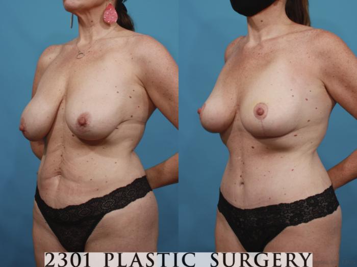 Before & After Tummy Tuck Case 664 Left Oblique View in Fort Worth, Plano, & Frisco, Texas