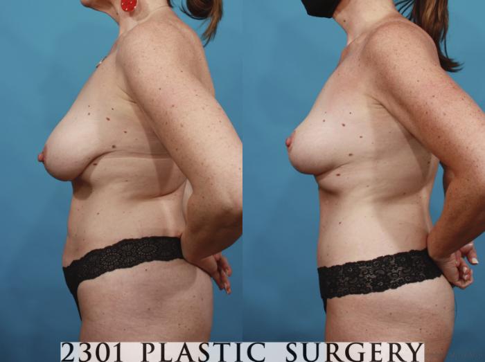 Before & After Breast Lift (Mastopexy) Case 664 Left Side View in Fort Worth, Plano, & Frisco, Texas