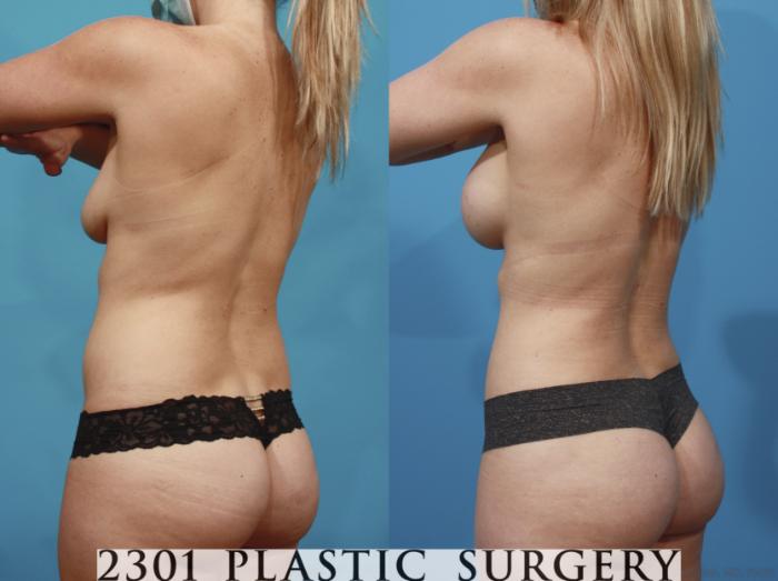 Before & After Silicone Implants Case 665 Back Left Oblique View in Fort Worth, Plano, & Frisco, Texas