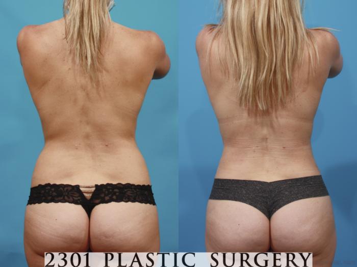 Before & After Breast Augmentation Case 665 Back View in Fort Worth, Plano, & Frisco, Texas