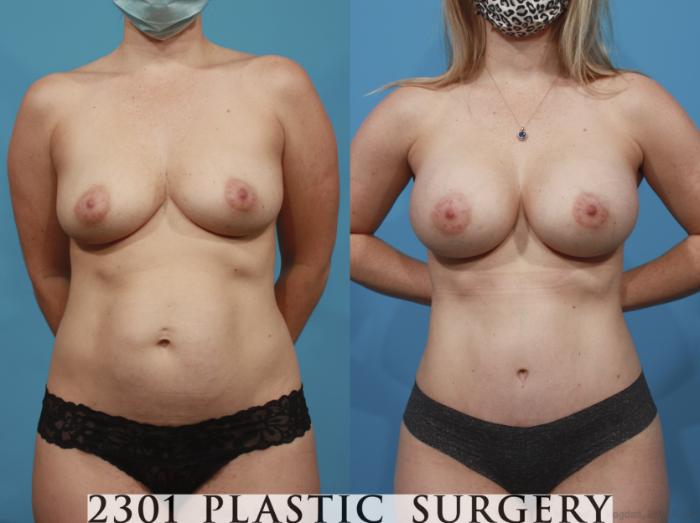 Before & After Silicone Implants Case 665 Front View in Fort Worth, Plano, & Frisco, Texas