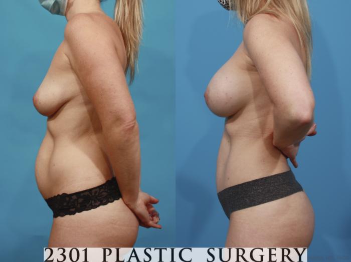 Before & After Silicone Implants Case 665 Left Side View in Fort Worth, Plano, & Frisco, Texas
