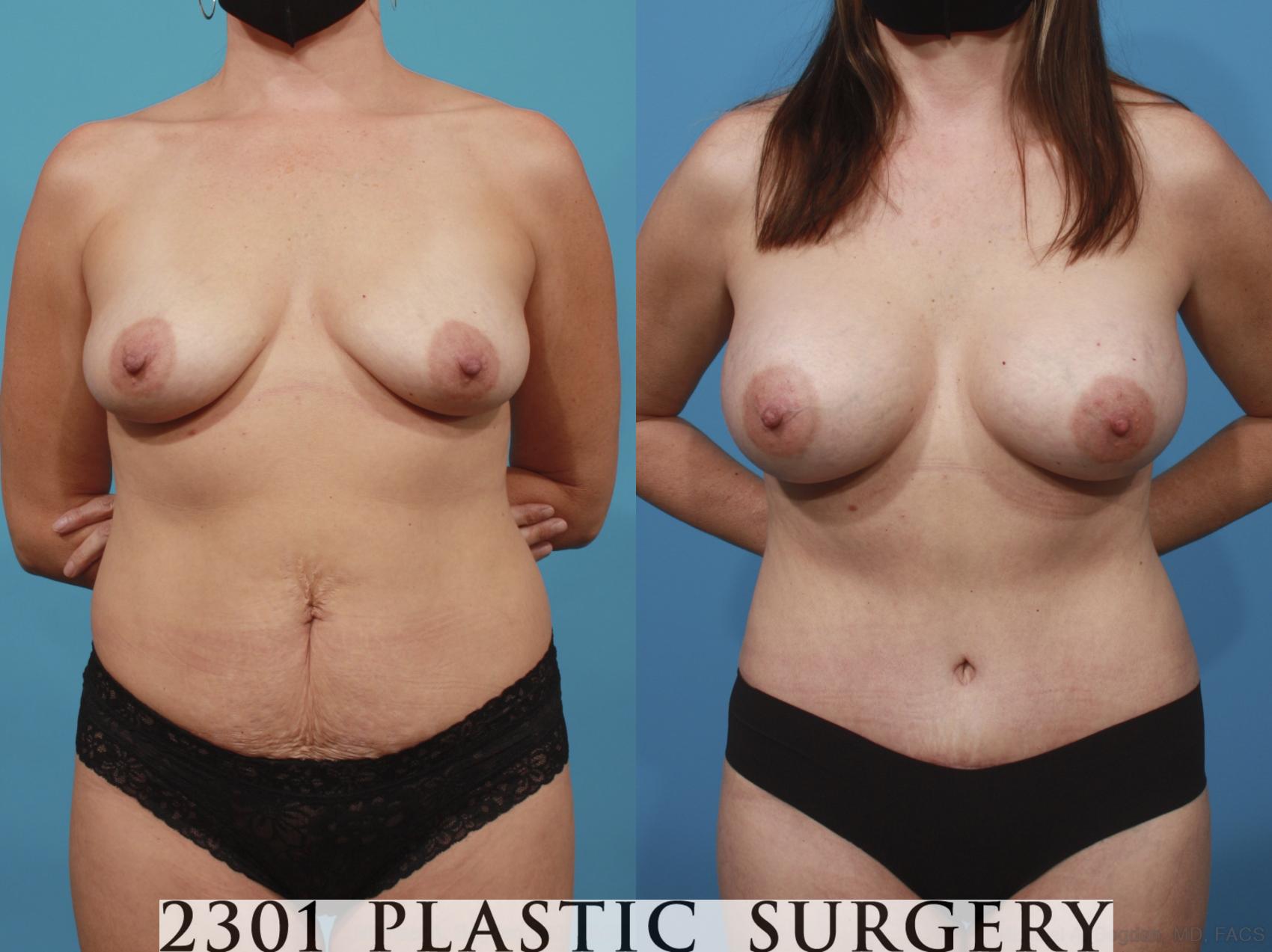 Before & After Breast Augmentation Case 666 Front View in Fort Worth, Plano, & Frisco, Texas