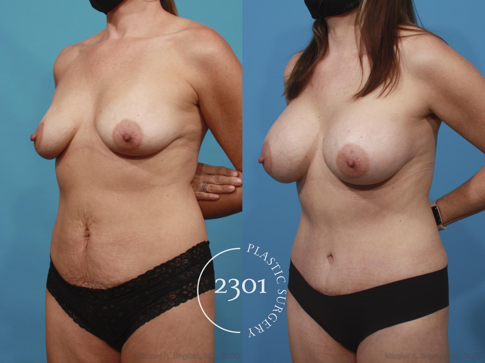 Before & After Mommy Makeover Case 666 Left Oblique View in Fort Worth, Plano, & Frisco, Texas