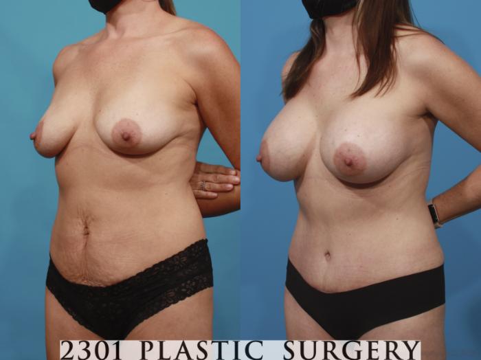 Before & After Breast Augmentation Case 666 Left Oblique View in Fort Worth, Plano, & Frisco, Texas