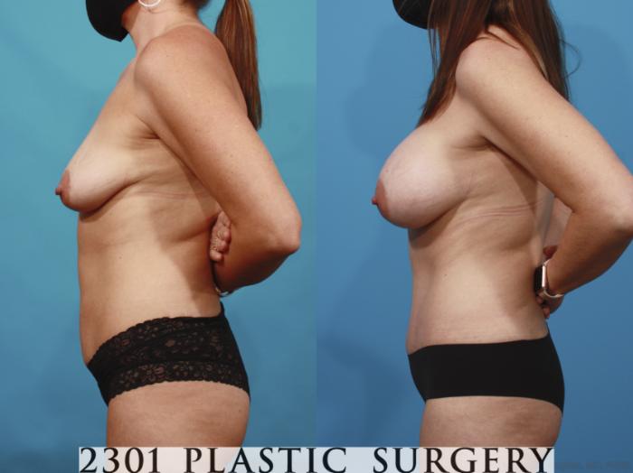 Before & After Mommy Makeover Case 666 Left Side View in Fort Worth, Plano, & Frisco, Texas