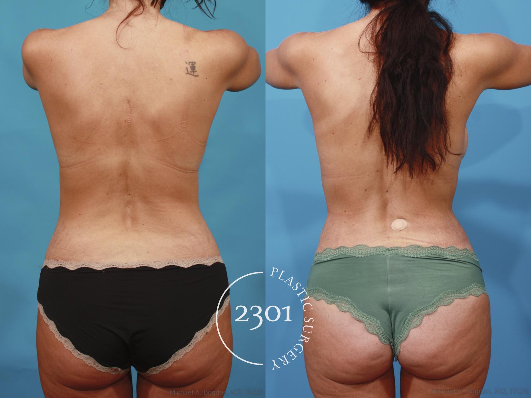 Before & After Silicone Implants Case 667 Back View in Fort Worth, Plano, & Frisco, Texas