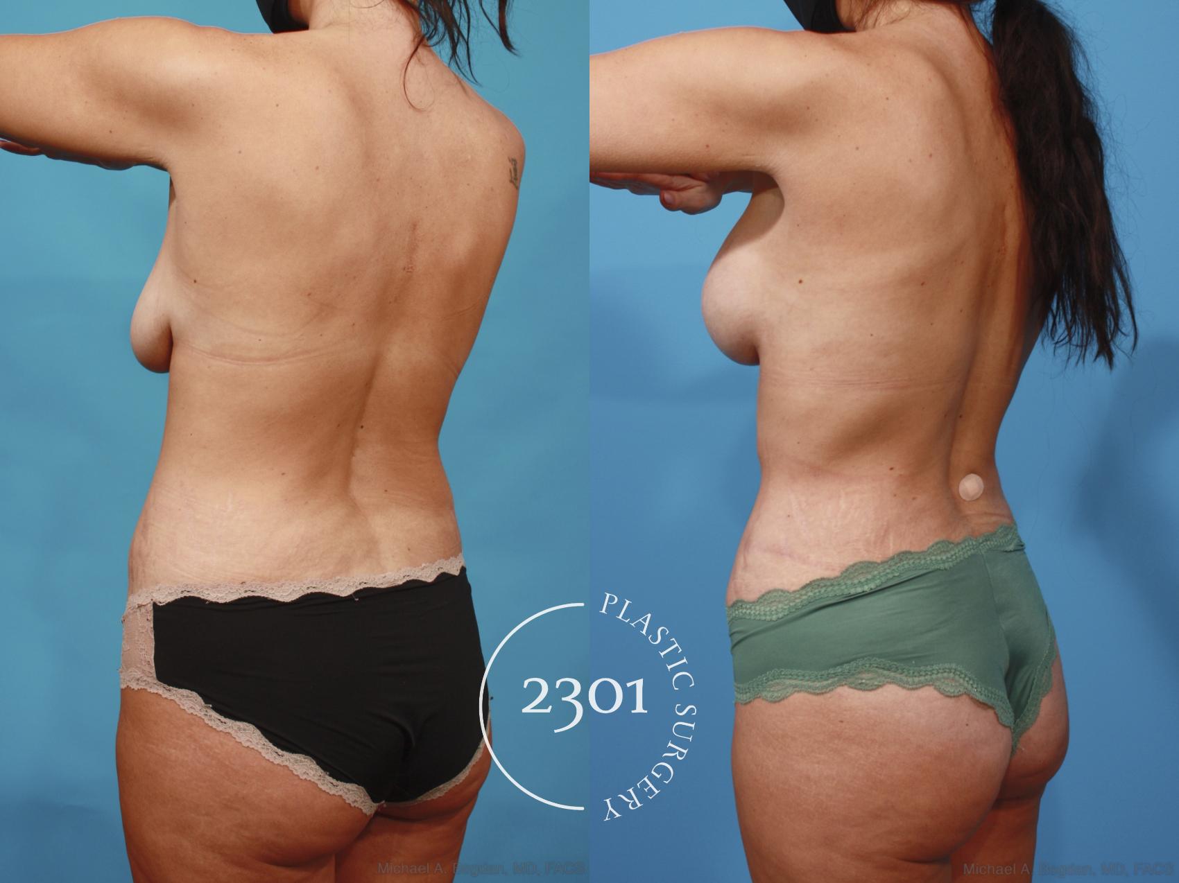 Before & After Silicone Implants Case 667 Back Left Oblique View in Fort Worth, Plano, & Frisco, Texas