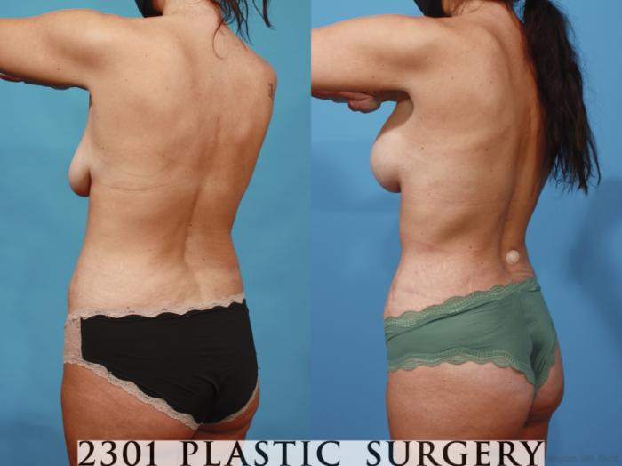 Before & After Mommy Makeover Case 667 Back Left Oblique View in Fort Worth, Plano, & Frisco, Texas