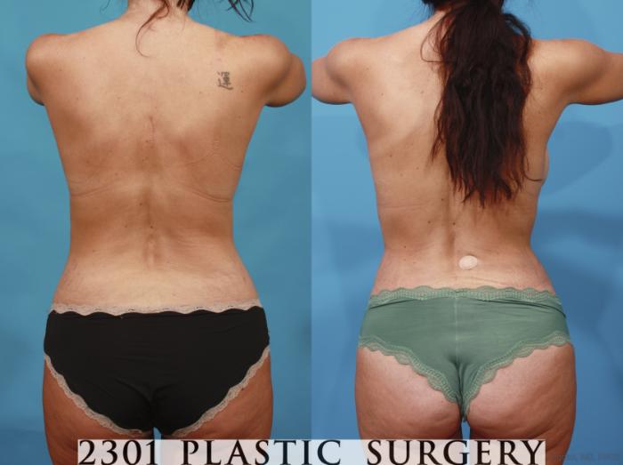 Before & After Silicone Implants Case 667 Back View in Fort Worth, Plano, & Frisco, Texas