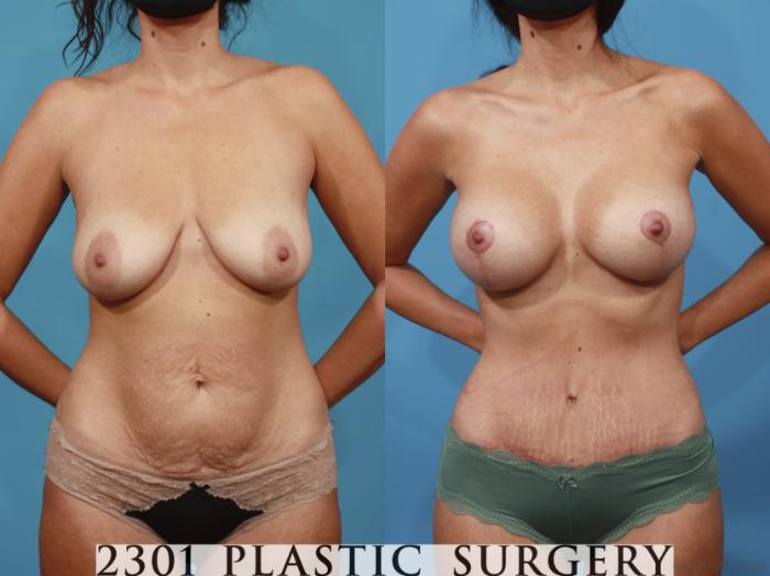 Before & After Mastopexy & Augmentation Case 667 Front View in Fort Worth, Plano, & Frisco, Texas