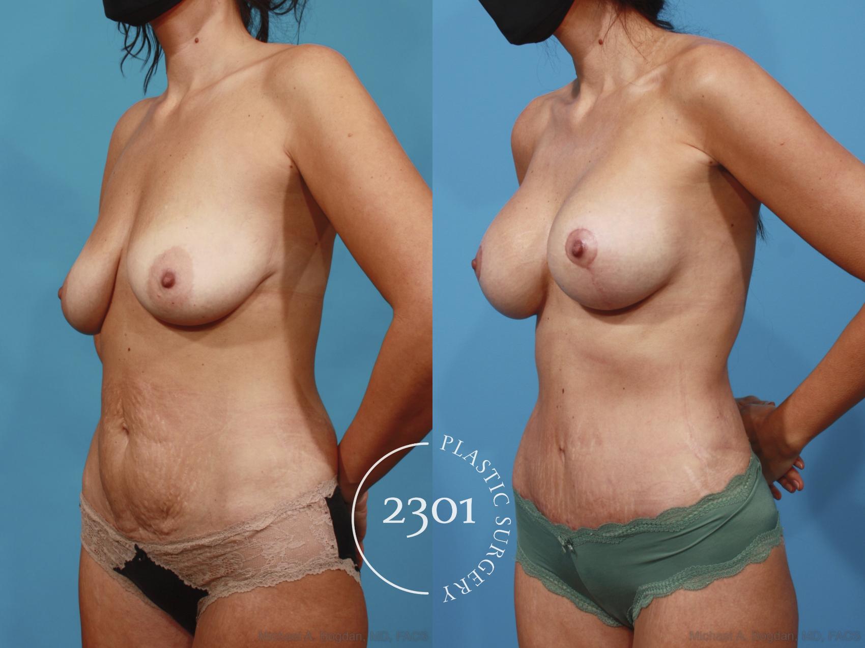 Before & After Silicone Implants Case 667 Left Oblique View in Fort Worth, Plano, & Frisco, Texas