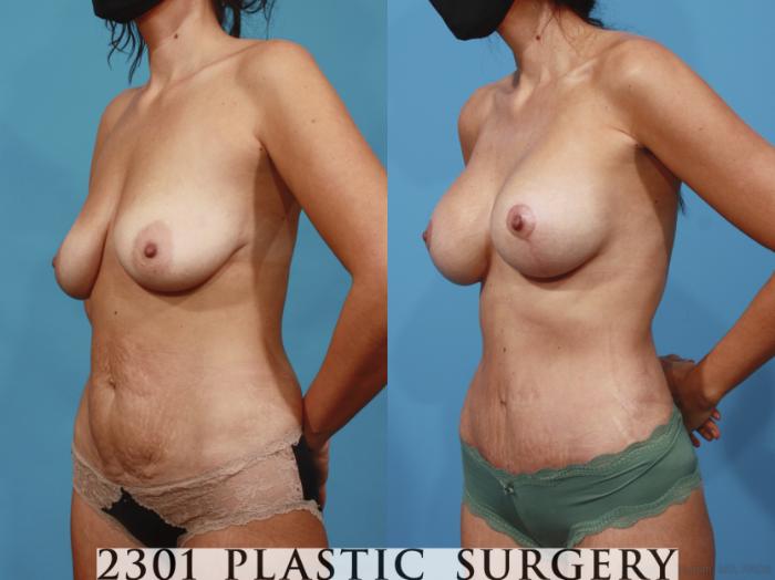 Before & After Mommy Makeover Case 667 Left Oblique View in Fort Worth, Plano, & Frisco, Texas