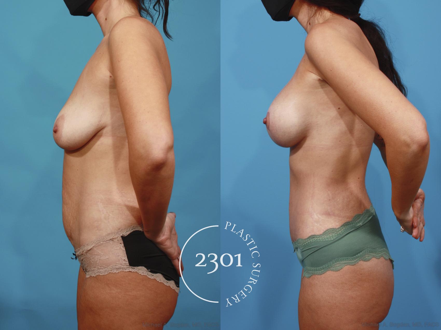 Before & After Silicone Implants Case 667 Left Side View in Fort Worth, Plano, & Frisco, Texas