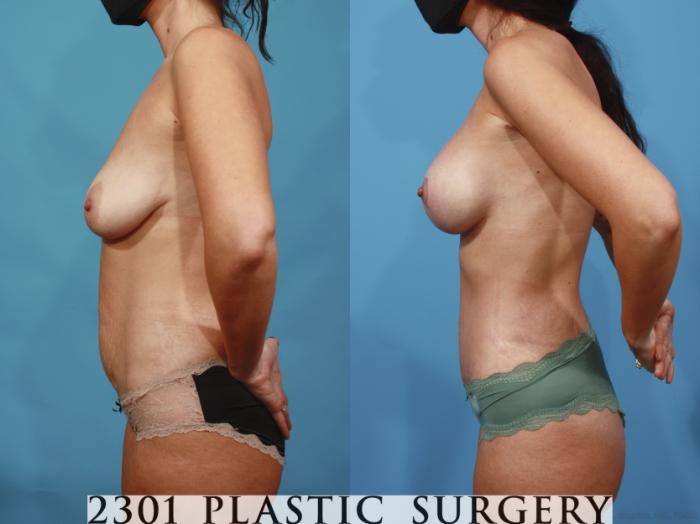 Before & After Silicone Implants Case 667 Left Side View in Fort Worth, Plano, & Frisco, Texas