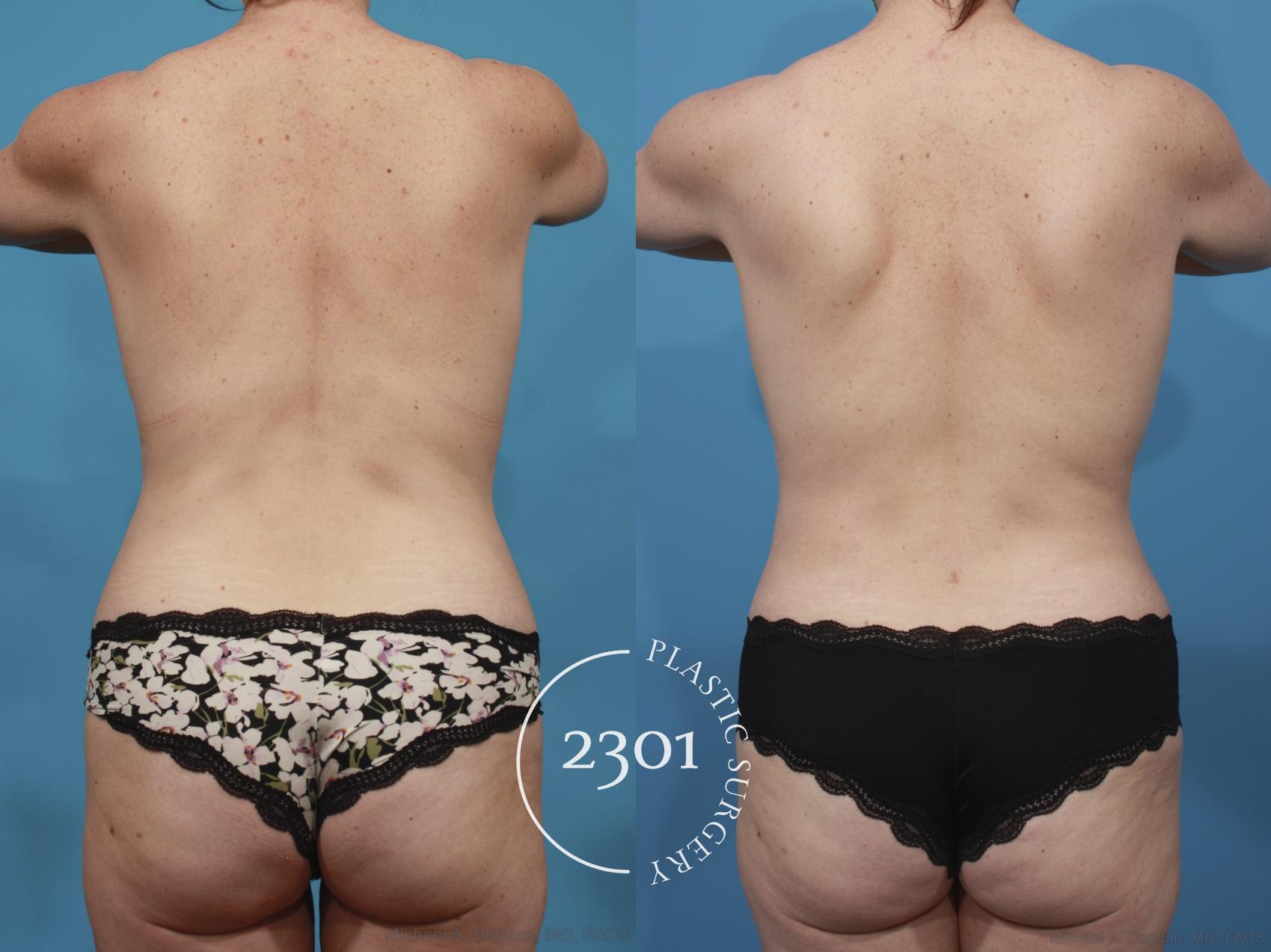 Before & After Mommy Makeover Case 668 Back View in Fort Worth, Plano, & Frisco, Texas