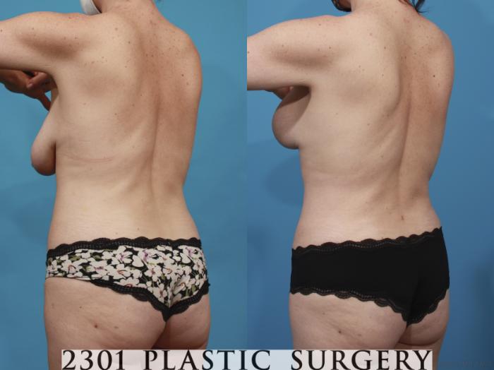 Before & After Breast Lift (Mastopexy) Case 668 Back Left Oblique View in Fort Worth, Plano, & Frisco, Texas