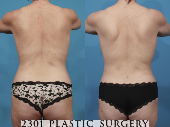 Before & After Mommy Makeover Case 668 Back View in Fort Worth, Plano, & Frisco, Texas