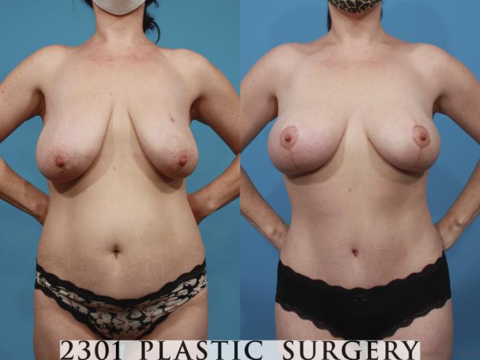 Before & After Breast Lift (Mastopexy) Case 668 Front View in Fort Worth, Plano, & Frisco, Texas