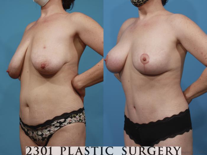 Before & After Breast Lift (Mastopexy) Case 668 Left Oblique View in Fort Worth, Plano, & Frisco, Texas