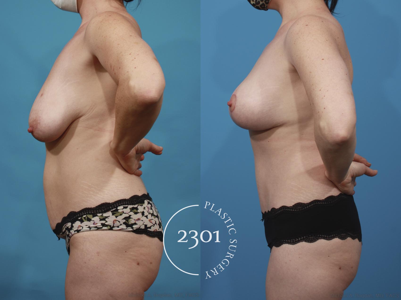 Before & After Mommy Makeover Case 668 Left Side View in Fort Worth, Plano, & Frisco, Texas