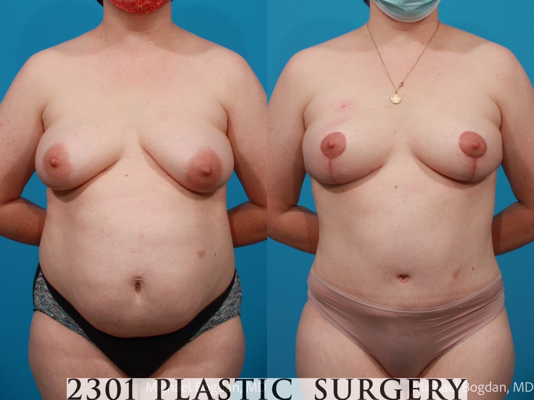 Before & After Tummy Tuck Case 672 Front View in Fort Worth, Plano, & Frisco, Texas