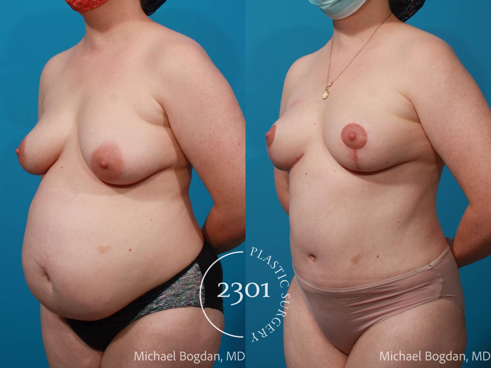 Before & After Mommy Makeover Case 672 Left Oblique View in Fort Worth, Plano, & Frisco, Texas