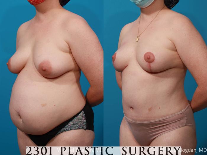 Before & After Tummy Tuck Case 672 Left Oblique View in Fort Worth, Plano, & Frisco, Texas