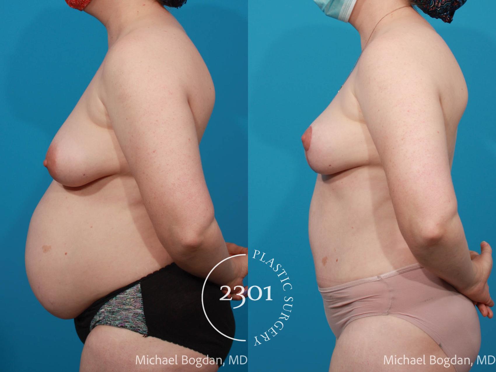 Before & After Mommy Makeover Case 672 Left Side View in Fort Worth, Plano, & Frisco, Texas