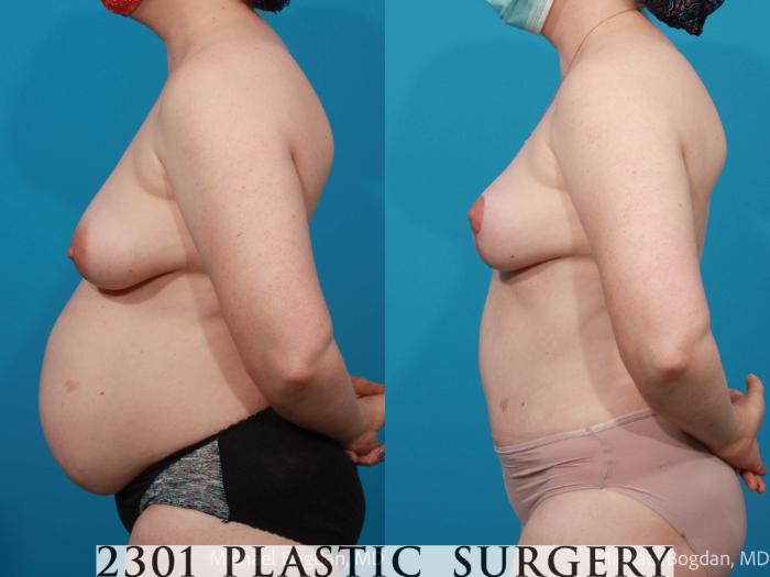 Before & After Tummy Tuck Case 672 Left Side View in Fort Worth, Plano, & Frisco, Texas
