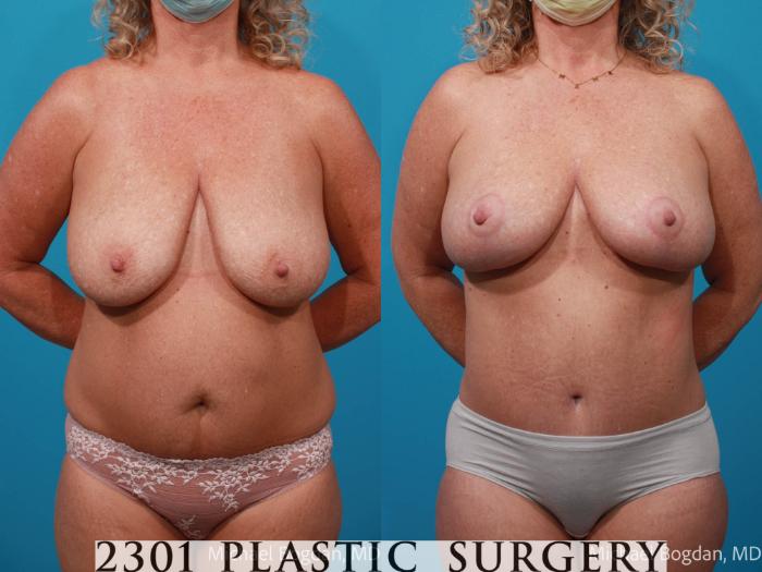 Before & After Mommy Makeover Case 673 Front View in Fort Worth, Plano, & Frisco, Texas