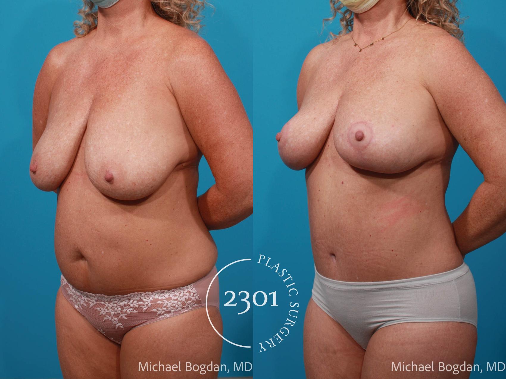 Before & After Mommy Makeover Case 673 Left Oblique View in Fort Worth, Plano, & Frisco, Texas