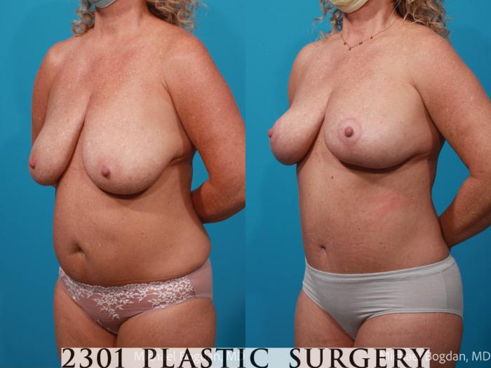 Before & After Mommy Makeover Case 673 Left Oblique View in Fort Worth, Plano, & Frisco, Texas