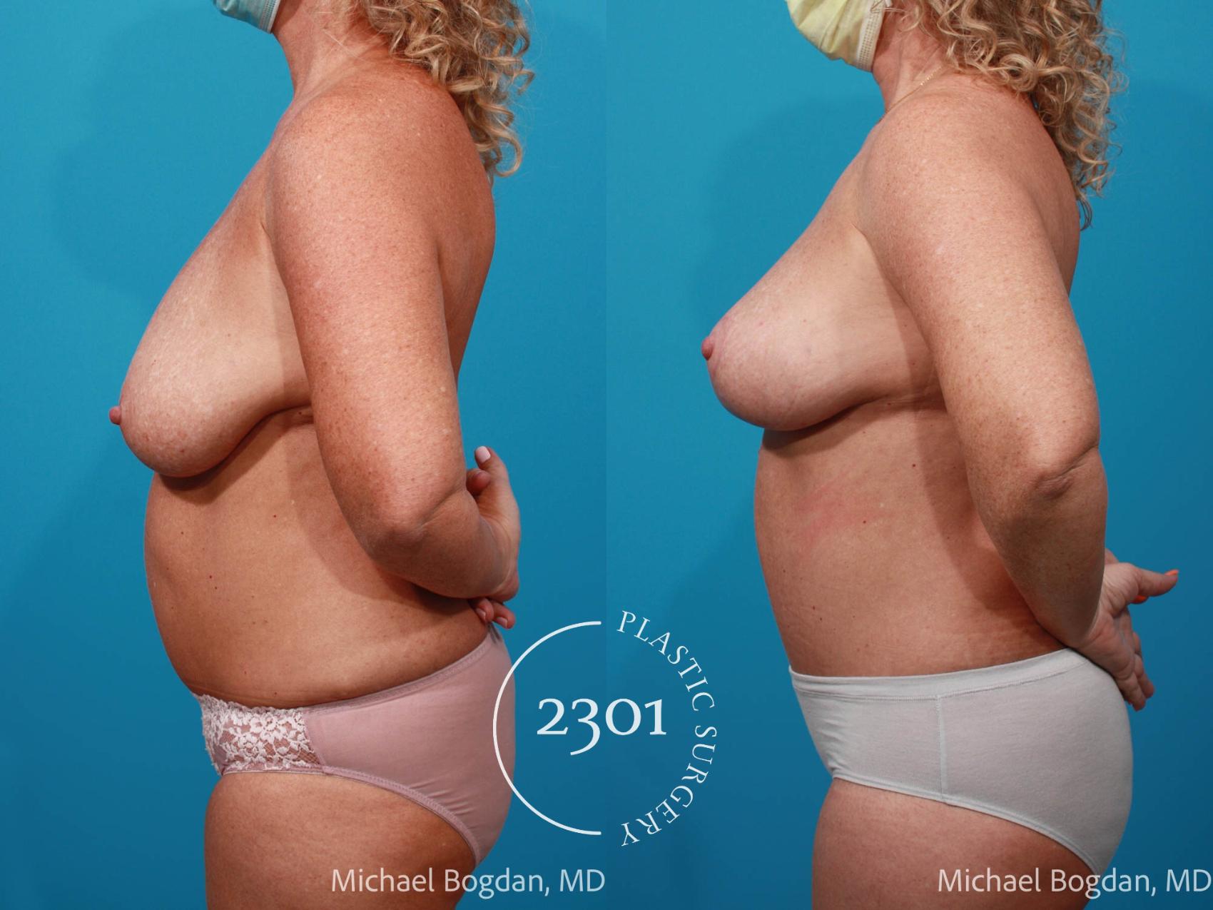 Before & After Mommy Makeover Case 673 Left Side View in Fort Worth, Plano, & Frisco, Texas