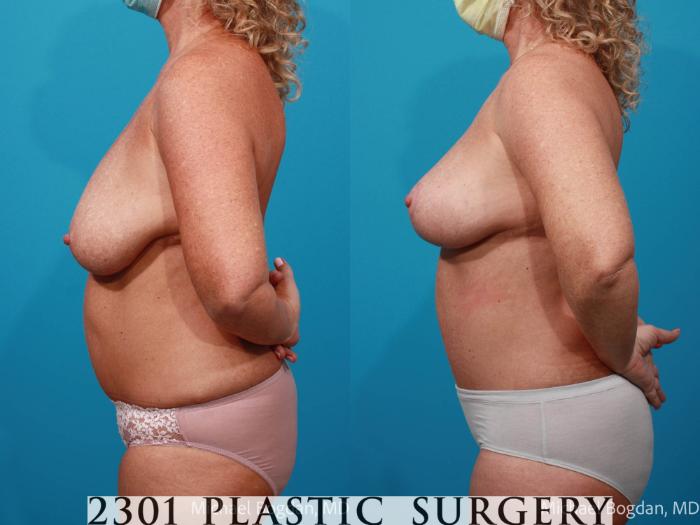 Before & After Breast Lift (Mastopexy) Case 673 Left Side View in Fort Worth, Plano, & Frisco, Texas