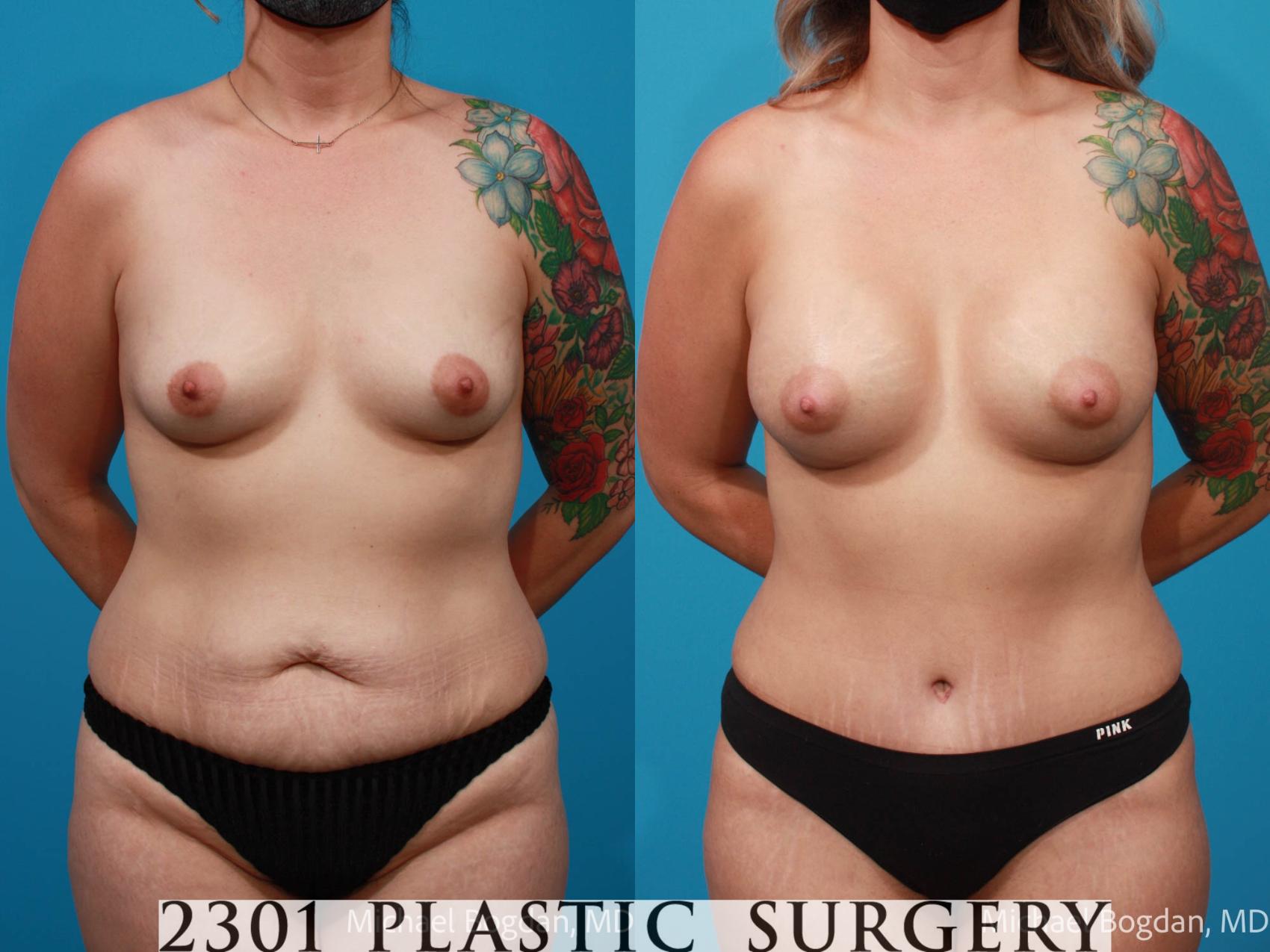 Before & After Breast Augmentation Case 674 Front View in Fort Worth, Plano, & Frisco, Texas