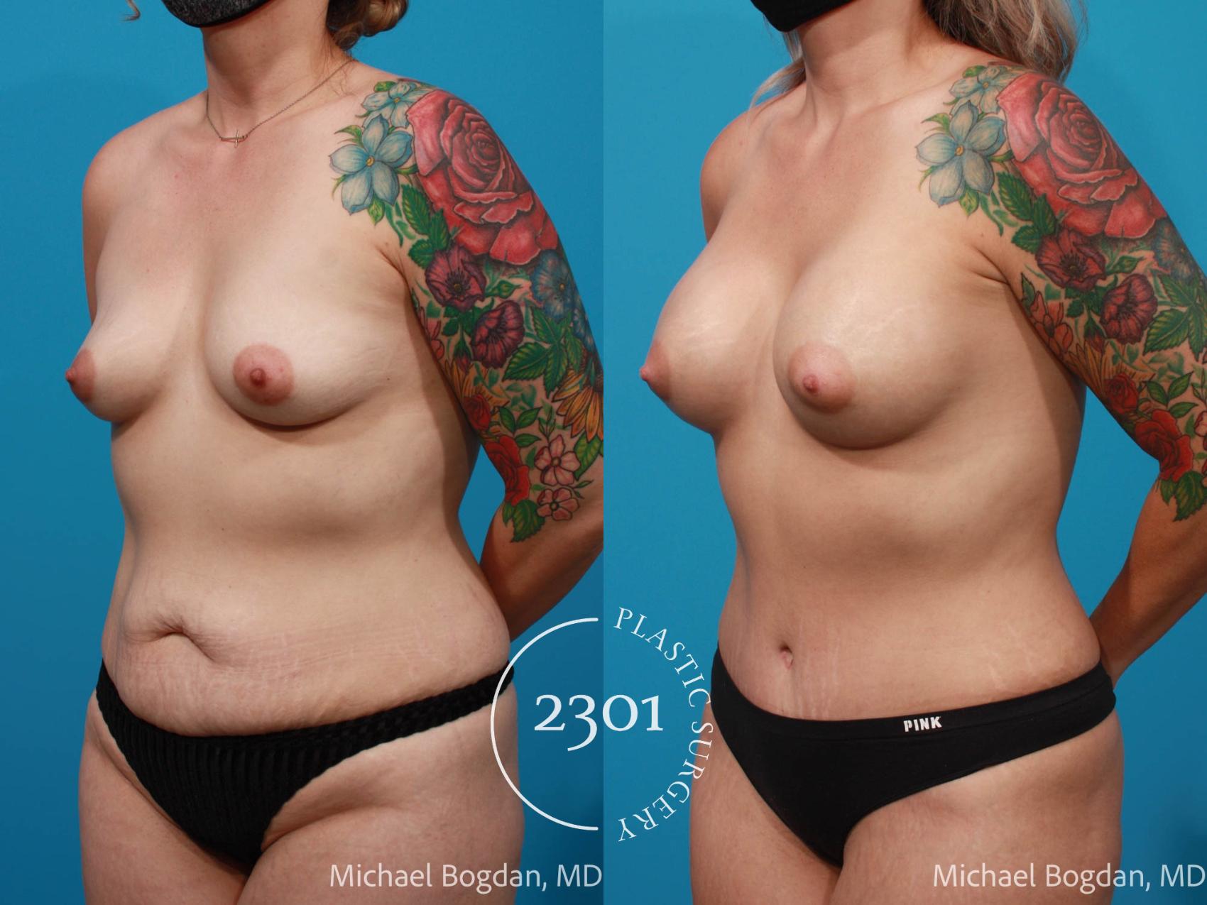 Before & After Silicone Implants Case 674 Left Oblique View in Fort Worth, Plano, & Frisco, Texas
