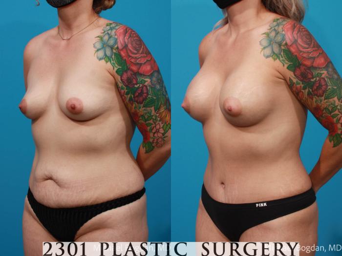 Before & After Breast Augmentation Case 674 Left Oblique View in Fort Worth, Plano, & Frisco, Texas