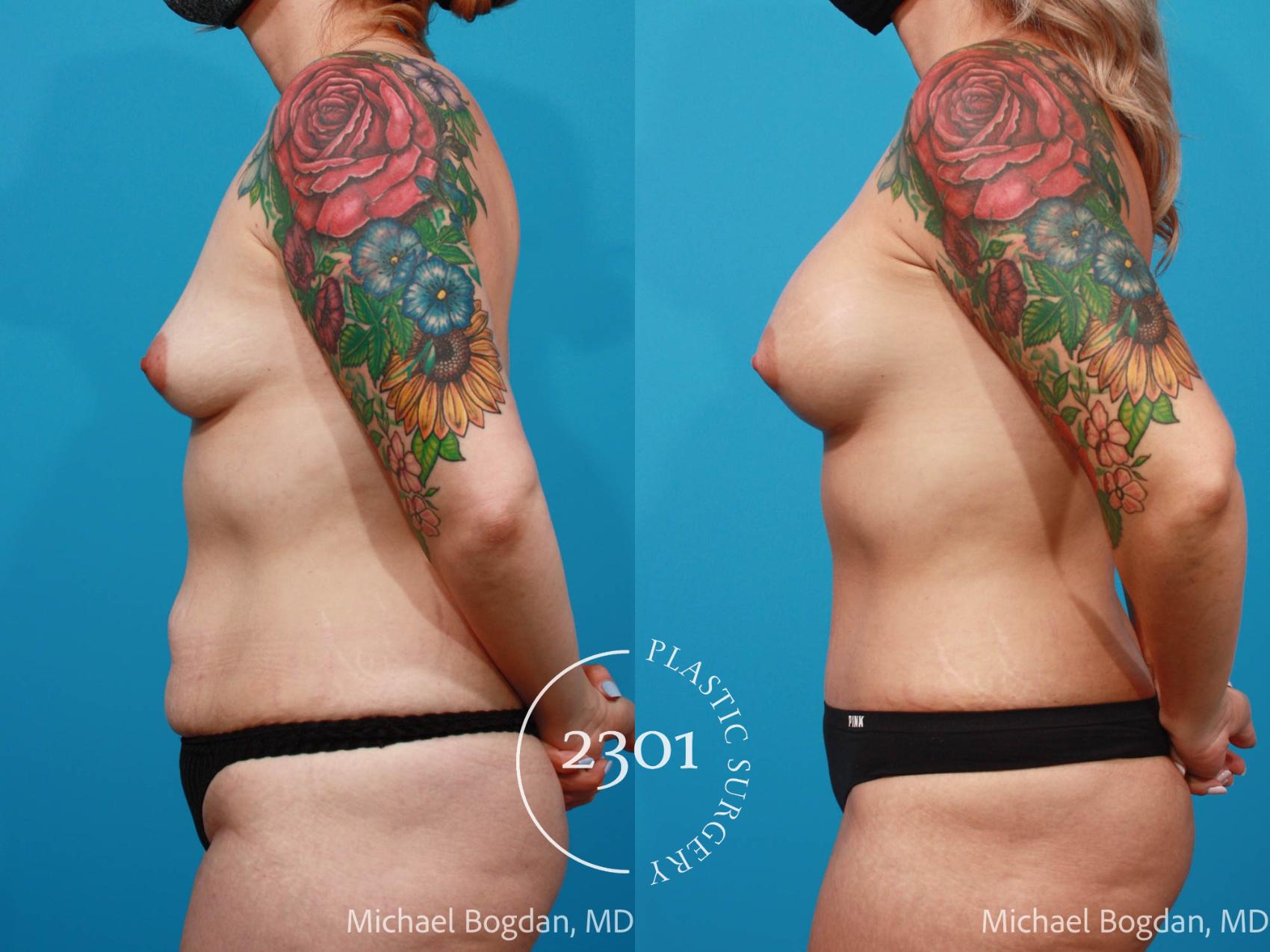 Before & After Silicone Implants Case 674 Left Side View in Fort Worth, Plano, & Frisco, Texas