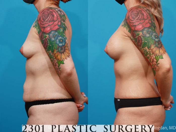 Before & After Breast Augmentation Case 674 Left Side View in Fort Worth, Plano, & Frisco, Texas