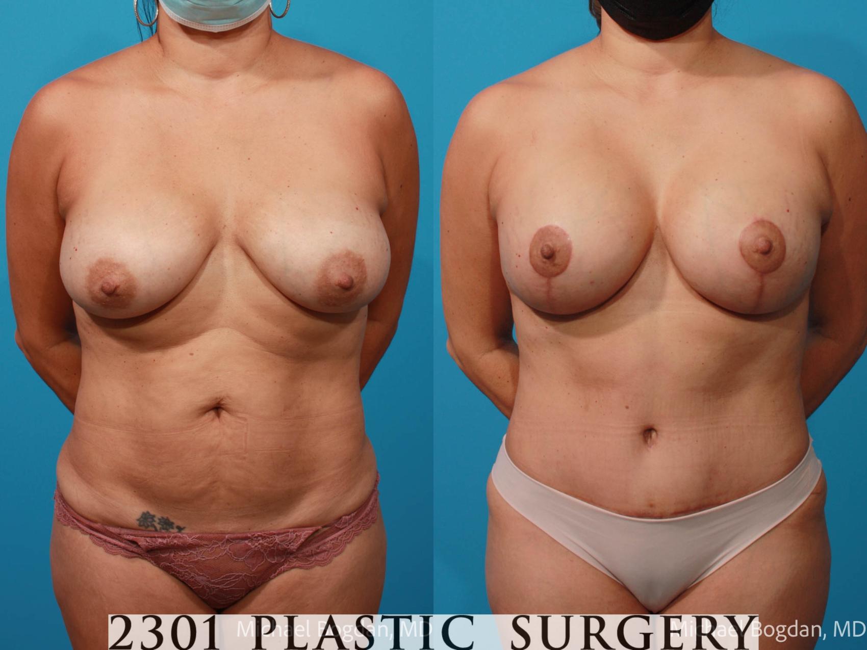 Before & After Tummy Tuck Case 680 Front View in Fort Worth, Plano, & Frisco, Texas