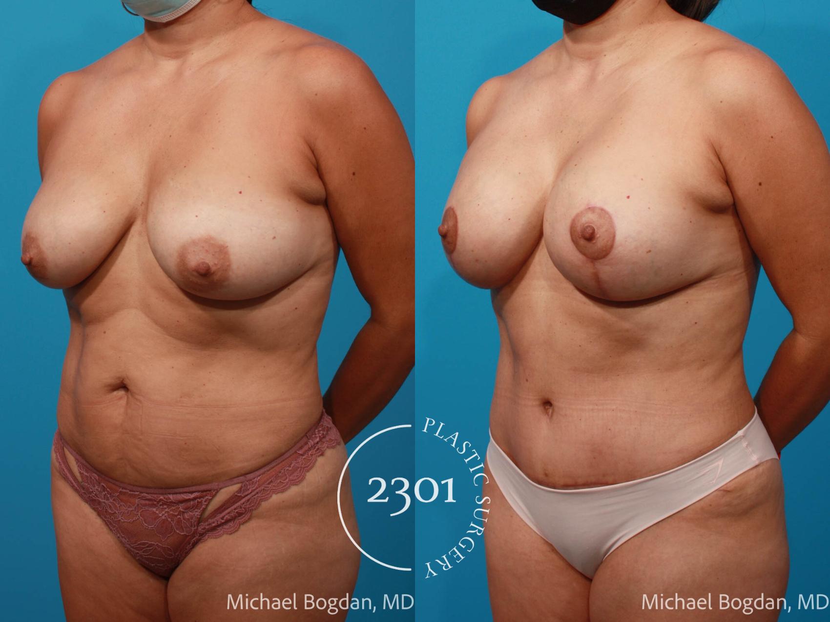Before & After Mommy Makeover Case 680 Left Oblique View in Fort Worth, Plano, & Frisco, Texas
