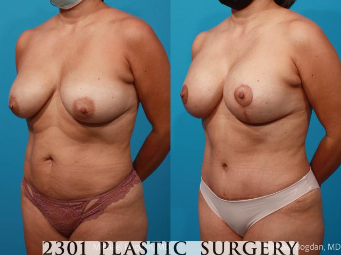 Before & After Breast Augmentation Revision Case 680 Left Oblique View in Fort Worth, Plano, & Frisco, Texas