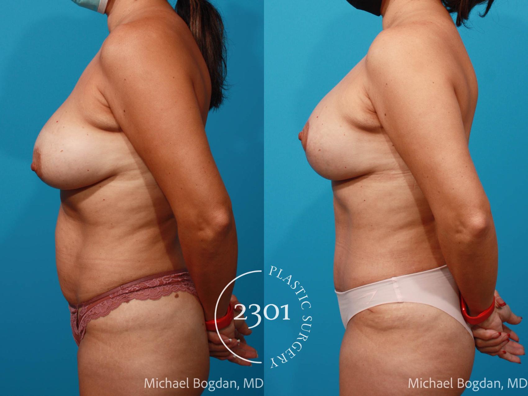 Before & After Mommy Makeover Case 680 Left Side View in Fort Worth, Plano, & Frisco, Texas