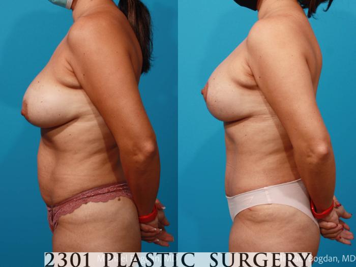 Before & After Breast Augmentation Revision Case 680 Left Side View in Fort Worth, Plano, & Frisco, Texas